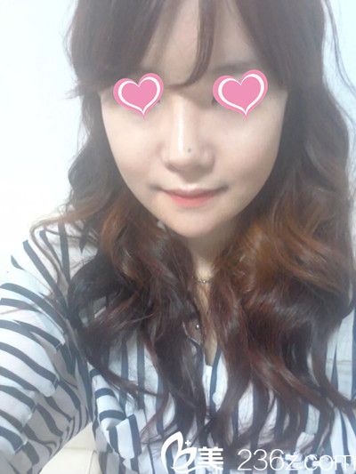 韓國星期八整形醫(yī)院面部輪廓手術(shù)案例