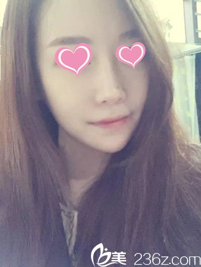 韓哪家醫(yī)院做面部輪廓手術(shù)好？分享下妹子在韓國星期八整形做顴骨顴弓整形+下頜角手術(shù)過程