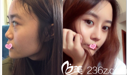 北京葉子鼻修復(fù)案例 北京葉子鼻修復(fù)案例