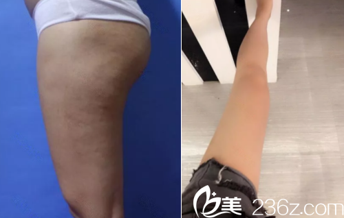 北京葉子腿部吸脂案例 北京葉子腿部吸脂案例