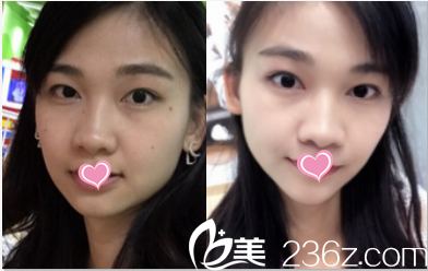 北京葉子激光點(diǎn)痣案例 北京葉子激光點(diǎn)痣案例