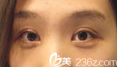 術(shù)后7天眼睛微腫