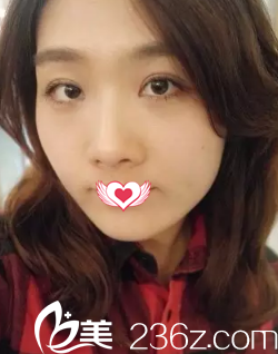 恢復(fù)12天的眼睛大而有神