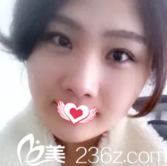 在石家莊貴美人做切開(kāi)雙眼皮+開(kāi)眼角+祛眼袋手術(shù)后 我的單眼皮、眼部細(xì)紋、黑眼圈、眼袋問(wèn)題一并全解決了       