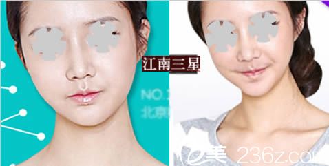 自從在韓國三星整形讓樸英進(jìn)院長做了面部輪廓整形后 原來我也可以這么美