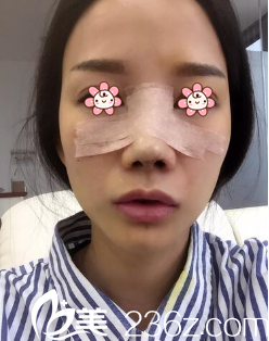 我去重慶美侖美奐醫(yī)院做完手術(shù)當(dāng)天 我去重慶美侖美奐醫(yī)院做完手術(shù)當(dāng)天