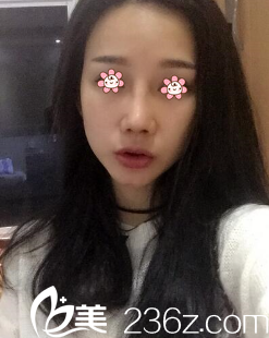 姬廣翰硅膠假體隆鼻術(shù)后一周 姬廣翰硅膠假體隆鼻術(shù)后一周