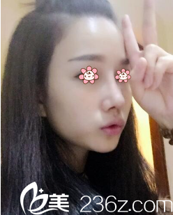 重慶美侖美奐硅膠隆鼻術(shù)后半個月 重慶美侖美奐硅膠隆鼻術(shù)后半個月