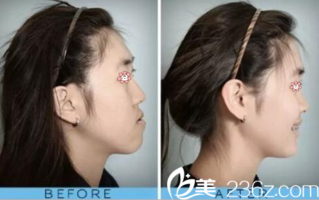 <!--<i data=20240703-sp></i>-->院長矯正突嘴案例