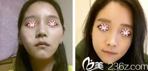 金壽信院長顴骨縮小手術(shù)案例 金壽信院長顴骨縮小手術(shù)案例