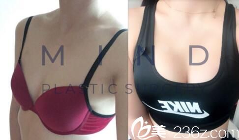 mind整形外科李永澤胸部整形真人前后對比 mind整形外科李永澤胸部整形真人前后對比