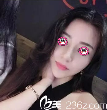 洪春鼻綜合隆鼻案例 洪春鼻綜合隆鼻案例