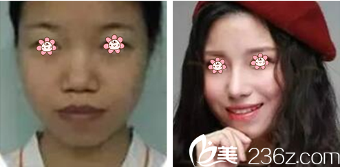 高應烈院長隆鼻案例