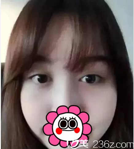 在北京葉子做眼修復前樣子 在北京葉子做眼修復前樣子