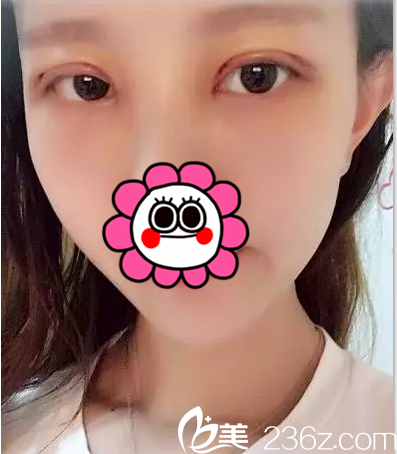 在北京葉子做雙眼皮修復第3天效果 在北京葉子做雙眼皮修復第3天效果