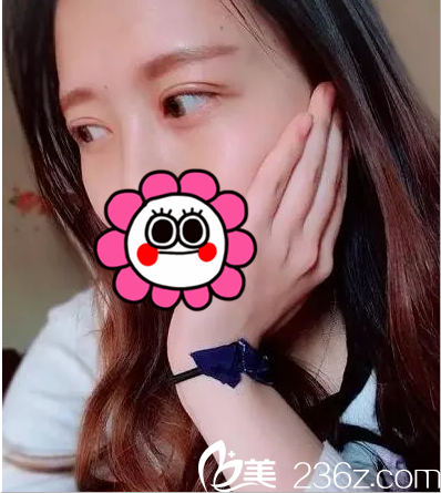 在北京葉子找魯禮新做眼修復第13天樣子 在北京葉子找魯禮新做眼修復第13天樣子