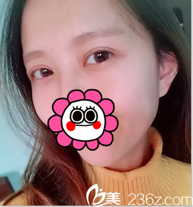 北京葉子雙眼皮修復案例 北京葉子雙眼皮修復案例