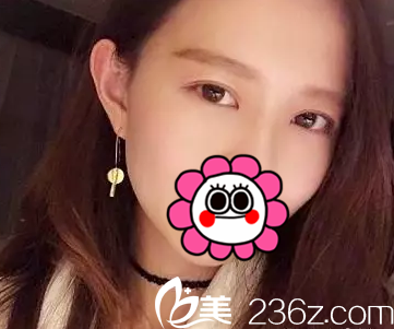 快來(lái)看北京葉子魯禮新雙眼皮修復(fù)第56天效果成這樣