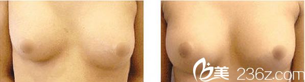 韓國(guó)美可整形假體隆胸術(shù)后效果對(duì)比圖 韓國(guó)美可整形假體隆胸術(shù)后效果對(duì)比圖
