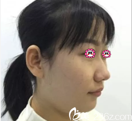 在北京葉子做面部吸脂前樣子 在北京葉子做面部吸脂前樣子