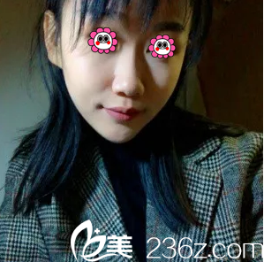 在北京葉子做面部吸脂第18天效果 在北京葉子做面部吸脂第18天效果