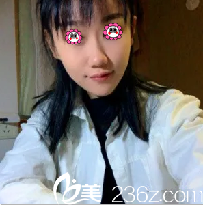 北京葉子面部吸脂案例 北京葉子面部吸脂案例