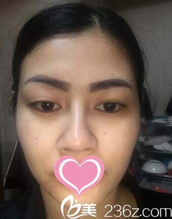 在韓國(guó)MIND醫(yī)院做雙眼皮術(shù)前照 在韓國(guó)MIND醫(yī)院做雙眼皮術(shù)前照