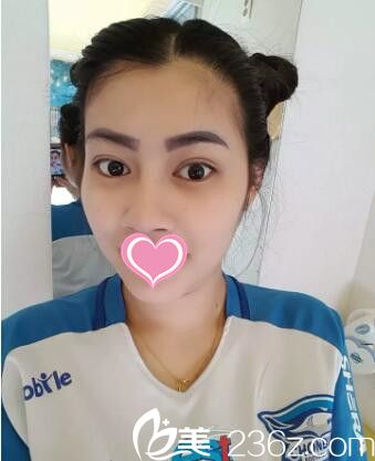 韓國做雙眼皮整形醫(yī)院哪家好？看我在韓國mind整形醫(yī)院做的雙眼皮效果怎么樣