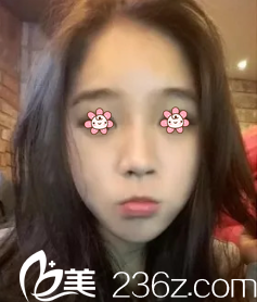 我主要是被韓國REAL整形外科金壽信的好口碑吸引過去做的顴骨縮小+下頜角手術(shù)。