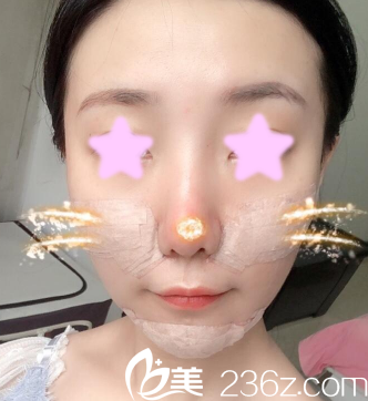 我在大同清木做面部自體脂肪填充后第3天照片