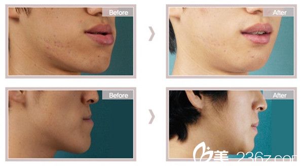 尹侯俊院長撅下巴(地包天)整形手術(shù)案例 尹侯俊院長撅下巴(地包天)整形手術(shù)案例