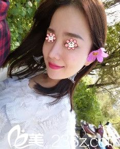 重慶時(shí)光整形假體隆鼻失敗修復(fù)術(shù)后40天