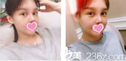 分享一個(gè)月前我在韓國(guó)VIZ找南成翰做的韓式雙眼皮+鼻綜合心里路程