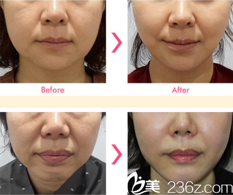 盧亨柱面部除皺案例對(duì)比圖 盧亨柱面部除皺案例對(duì)比圖