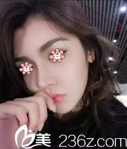 之前做的假體隆鼻鼻梁歪斜透光，現(xiàn)來了重慶賽格爾整形馬強這兒做鼻失敗修復。