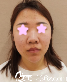 我在<!--<i data=20240703-sp></i>-->做鼻綜合之前的照片 我在<!--<i data=20240703-sp></i>-->做鼻綜合之前的照片