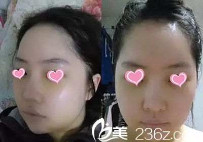 在韓國(guó)美多麗娜MEDITRINA整形醫(yī)院下頜角手術(shù)后一周 在韓國(guó)美多麗娜MEDITRINA整形醫(yī)院下頜角手術(shù)后一周