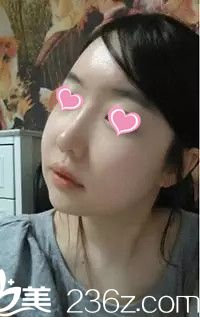 下頜角手術(shù)后半個(gè)月 下頜角手術(shù)后半個(gè)月