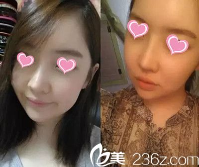 李成國(guó)院長(zhǎng)下頜角手術(shù)案例 李成國(guó)院長(zhǎng)下頜角手術(shù)案例