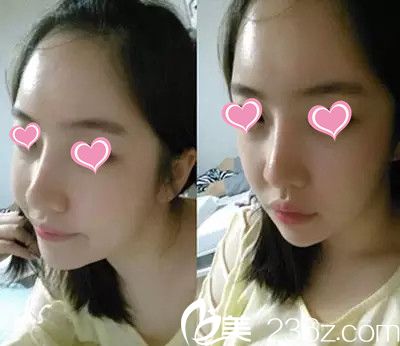 術(shù)后三個(gè)月 術(shù)后三個(gè)月