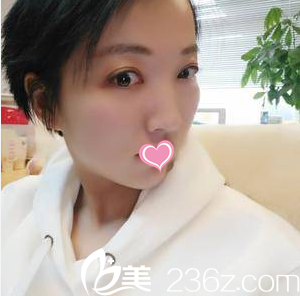 北京美萊韓式雙眼皮開眼角祛眼袋案例