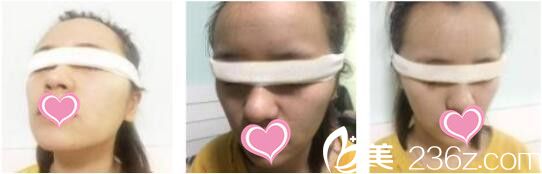 韓國原辰整形外科樸善熙韓式雙眼皮真人案例術(shù)后第二天