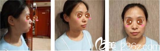 韓國原創(chuàng)整形外科閔成基假體隆鼻+鼻翼縮小真人案例術(shù)前照