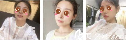 韓國原創(chuàng)整形外科閔成基假體隆鼻+鼻翼縮小真人案例術(shù)后第七天