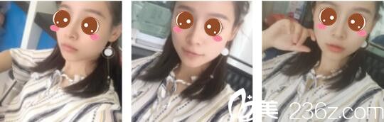 韓國原創(chuàng)整形外科閔成基假體隆鼻+鼻翼縮小真人案例術(shù)后三個月