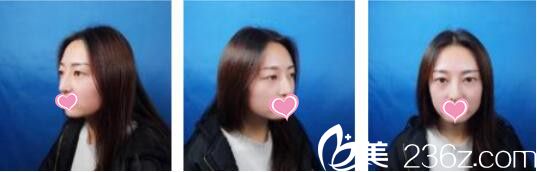 韓國ID整形醫(yī)院徐榮兌眼綜合真人案例術(shù)前照