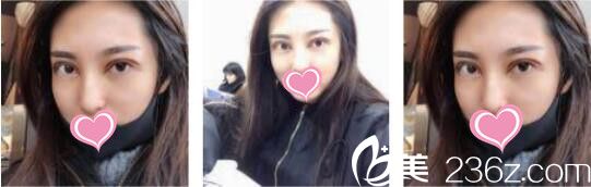 韓國ID整形醫(yī)院徐榮兌眼綜合真人案例術(shù)后第五天