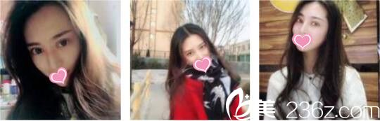 韓國ID整形醫(yī)院徐榮兌眼綜合真人案例術(shù)后一個月