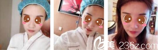 韓國ID整形醫(yī)院鄭承一假體隆鼻真人案例術(shù)前照