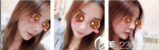 韓國ID整形醫(yī)院鄭承一假體隆鼻真人案例術(shù)后第七天